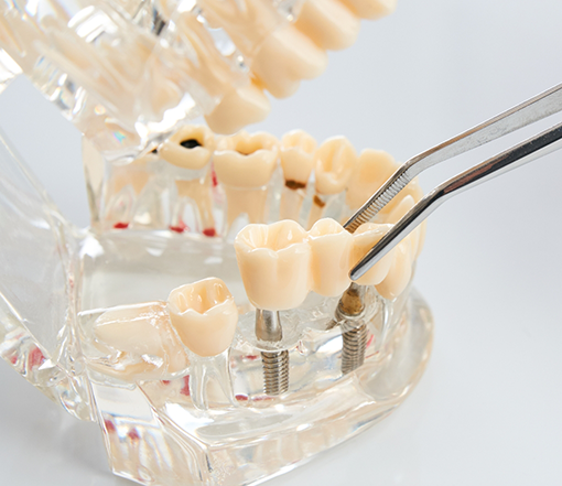 Model of the mouth with two dental implants in Forest Grove