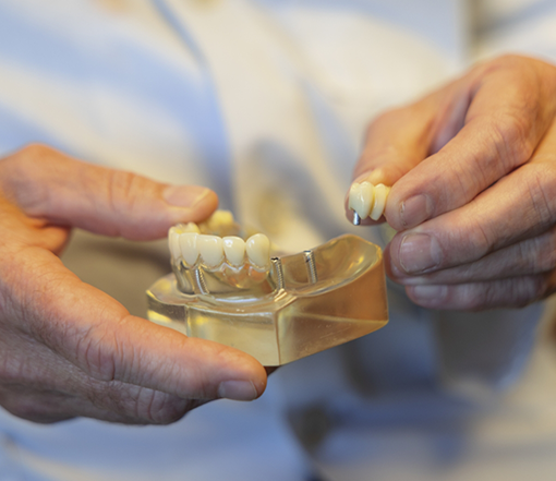 Dentist holding a model of a mouth with dental implants