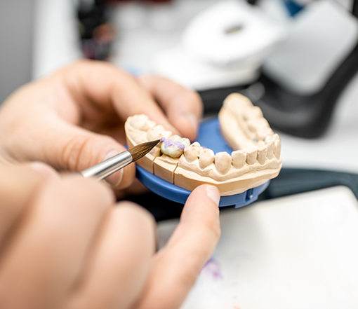Dentist adjusting a dental crown in a model of the mouth